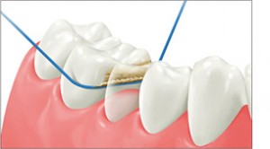 dental_floss